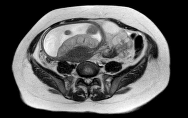 File:Colon adenocarcinoma with Krukenberg tumors, advanced pregnancy (Radiopaedia 67279-76645 Axial T2 28).jpg