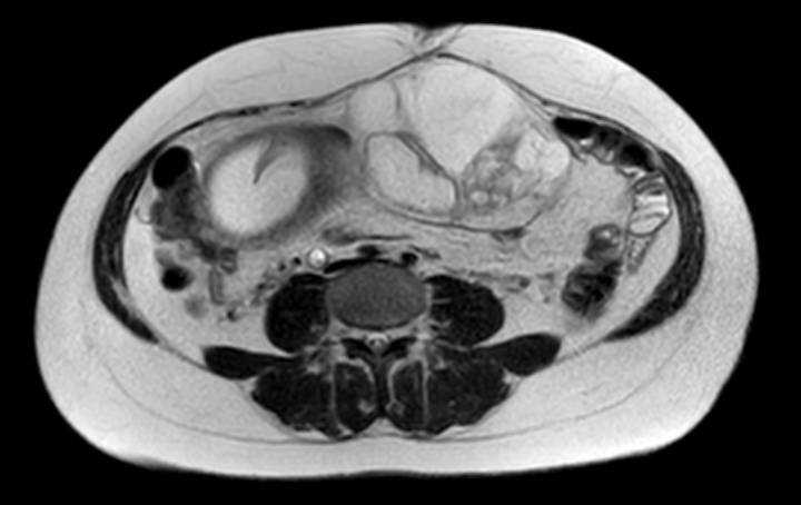 Colon adenocarcinoma with Krukenberg tumors, advanced pregnancy (Radiopaedia 67279-76645 Axial T2 36).jpg