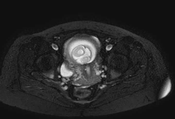Colon adenocarcinoma with Krukenberg tumors, advanced pregnancy (Radiopaedia 67279-76645 Axial T2 SPAIR 10).jpg