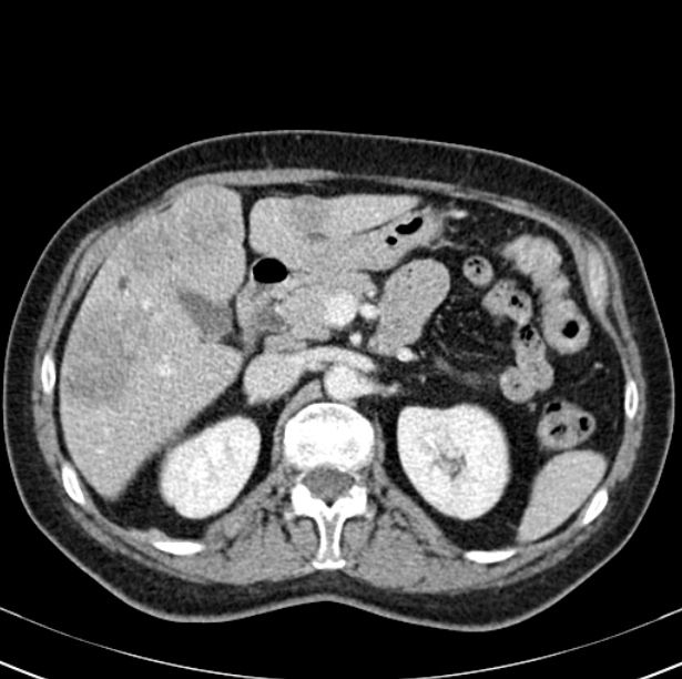 Colon carcinoma with hepatic metastases (Radiopaedia 29477-29961 A 38).jpg