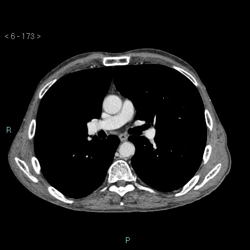 File:Colonic cancer (ultrasound and TC imaging) (Radiopaedia 50346-55713 B 173).jpg