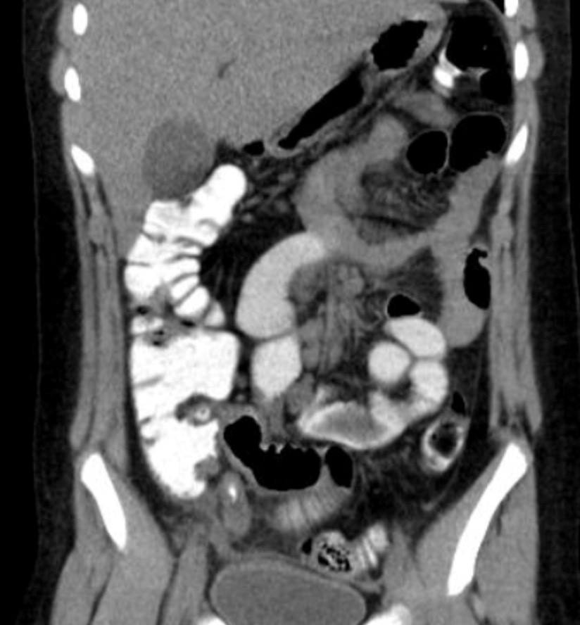 Figure 10.8B Coronal CT of an Adult Abdomen, demonstrating a thick-walled appendix with a calcified appendicolith.jpg