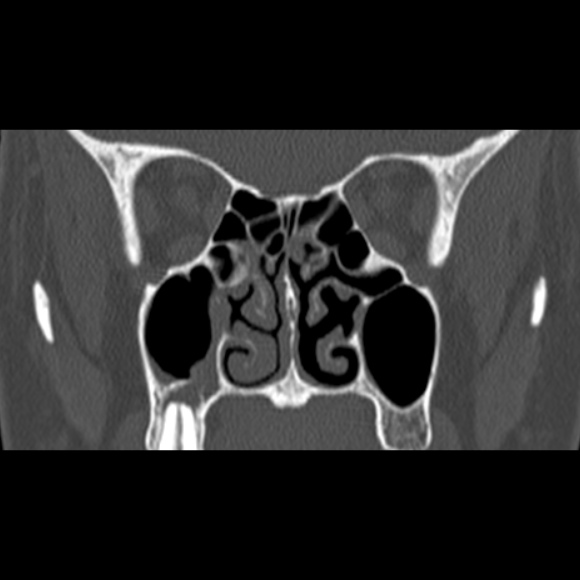 Nasal septal perforation (Radiopaedia 25030-25289 Coronal bone window 40).jpg