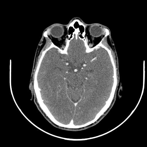 File:Nasopharyngeal carcinoma - infiltrating the clivus (Radiopaedia 62583-70875 Axial Post contrast 1).jpg