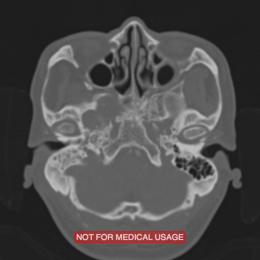 File:Nasopharyngeal carcinoma recurrence - skull base destruction (Radiopaedia 29107-29490 Axial bone window 88).jpg