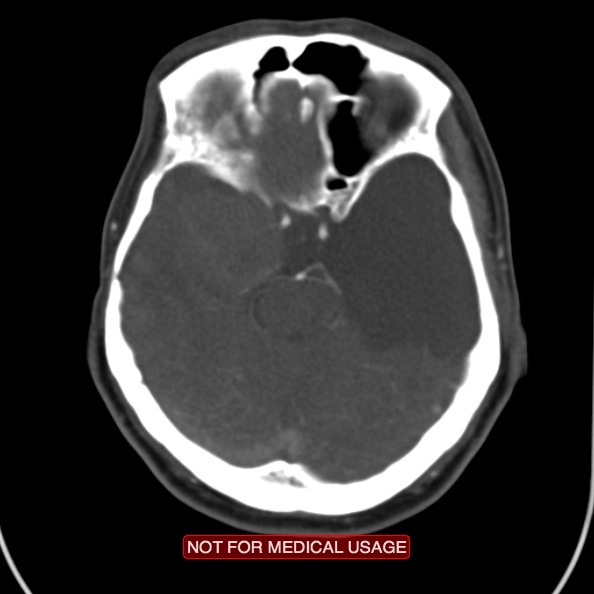 File:Nasopharyngeal carcinoma recurrence - skull base destruction (Radiopaedia 29107-29491 A 1).jpg