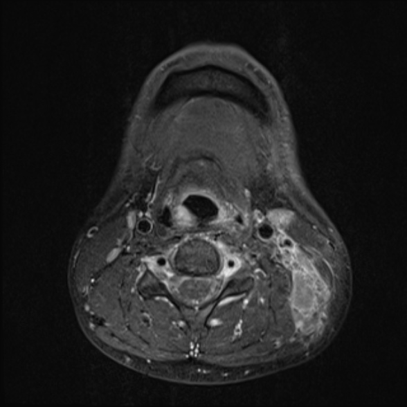 Nasopharyngeal carcinoma with skull base invasion (Radiopaedia 53415-59485 Axial T1 C+ fat sat 52).jpg