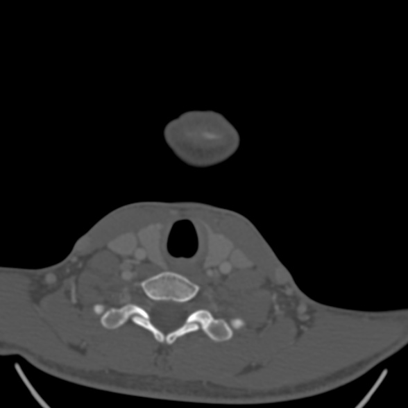 Nasopharyngeal carcinoma with skull base invasion (Radiopaedia 53415-59705 Axial bone window 169).jpg