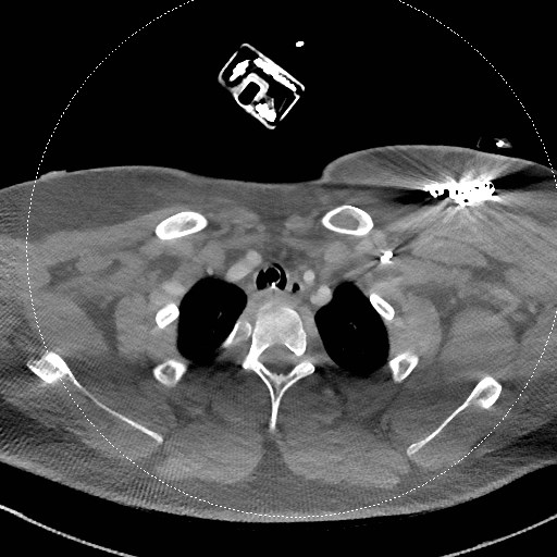 Neck CT angiogram (intraosseous vascular access) (Radiopaedia 55481-61945 B 93).jpg