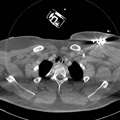 Neck CT angiogram (intraosseous vascular access) (Radiopaedia 55481-61945 B 94).jpg