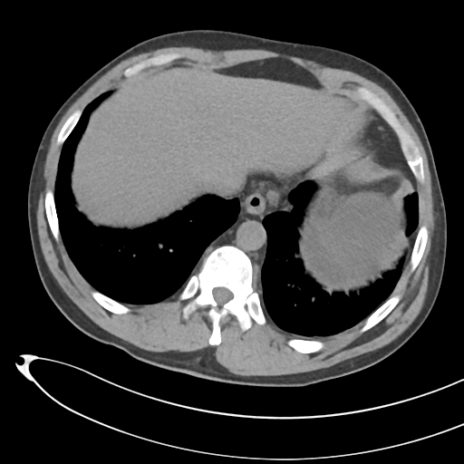 File:Necrotizing pancreatitis with acute necrotic collections (Radiopaedia 38829-41012 Axial non-contrast 12).png