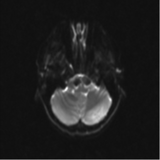 Neurenteric cyst (Radiopaedia 58641-65837 Axial DWI 8).png