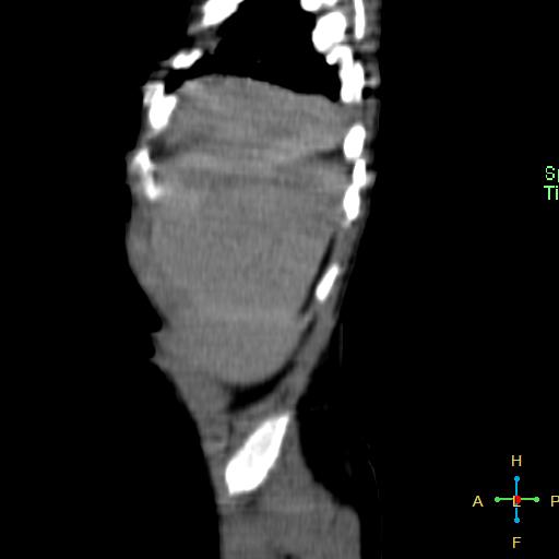 File:Neuroblastoma (Radiopaedia 24751-25016 C 28).jpg
