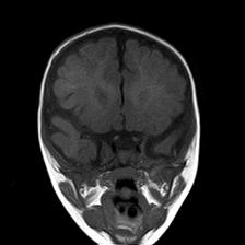 File:Neurofibromatosis type 1 (Radiopaedia 30089-30671 Coronal T1 10).jpg