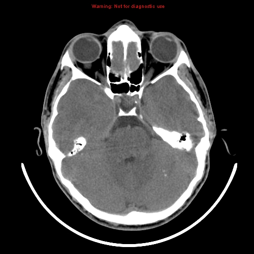 File:Neurofibromatosis type 2 (Radiopaedia 8953-9732 Axial non-contrast 11).jpg