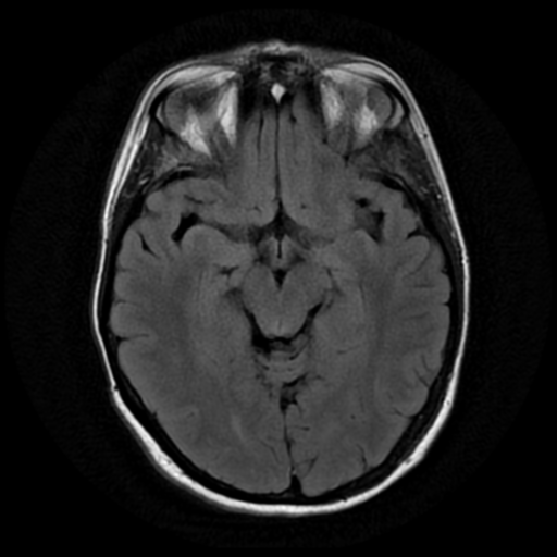 File:Neurofibromatosis type 2 - bilateral acoustic neuromata (Radiopaedia 40060-42566 Axial FLAIR 9).png