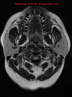 File:Neuroglial cyst (Radiopaedia 10713-11184 Axial FLAIR 23).jpg