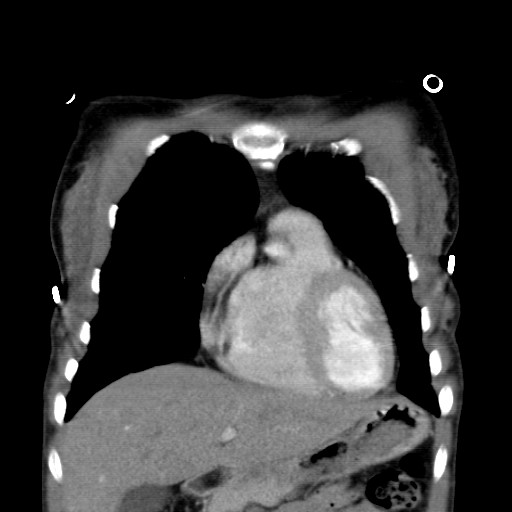 File:Non-small cell lung cancer with miliary metastases (Radiopaedia 23995-24193 B 5).jpg