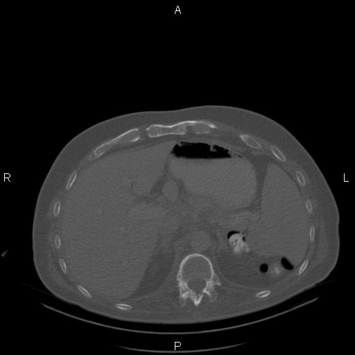 Non Hodgkin lymphoma in a patient with ankylosing spondylitis (Radiopaedia 84323-99624 Axial bone window 29).jpg