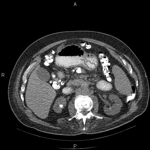 File:Non Hodgkin lymphoma in a patient with ankylosing spondylitis (Radiopaedia 84323-99624 Axial non-contrast 40).jpg