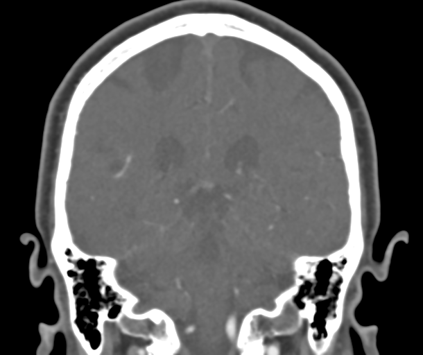 File:Normal CTA head (Radiopaedia 40801-43464 B 64).png