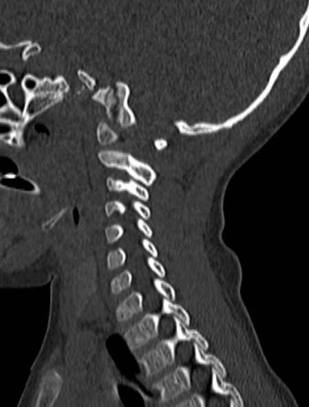 File:Normal CT cervical spine - pediatric (Radiopaedia 52549-58462 Sagittal bone window 60).jpg