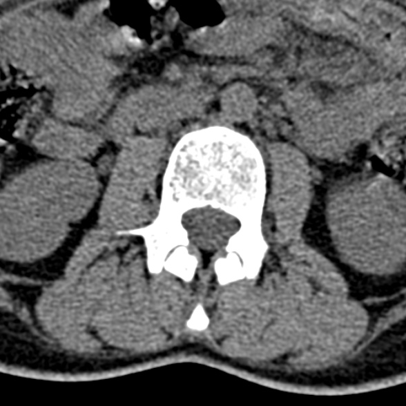 Normal CT lumbar spine (Radiopaedia 53981-60118 Axial non-contrast 44).jpg