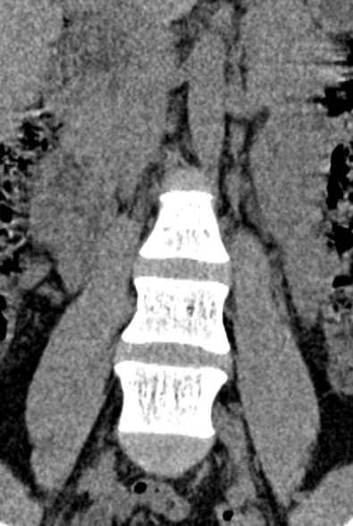 Normal CT lumbar spine (Radiopaedia 53981-60118 F 16).jpg
