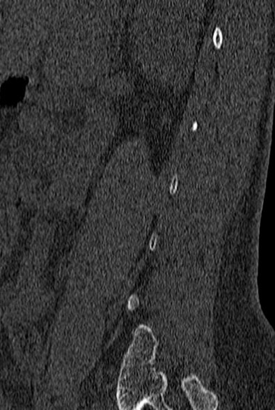 File:Normal CT lumbar spine (Radiopaedia 53981-60118 Sagittal bone window 81).jpg