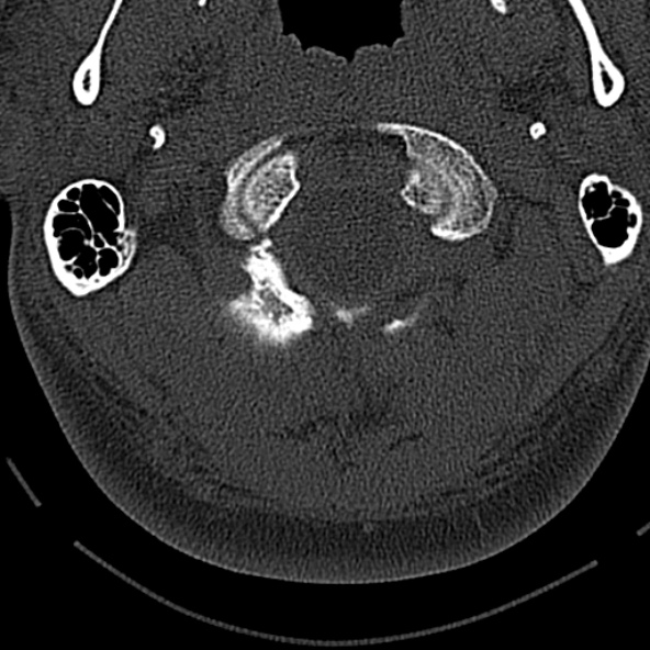 Normal CT of the cervical spine (Radiopaedia 53322-59305 Axial bone window 47).jpg