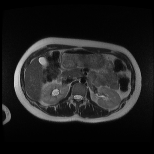 Normal MRI abdomen in pregnancy (Radiopaedia 88003-104546 Axial T2 9).jpg