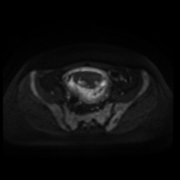 Normal MRI abdomen in pregnancy (Radiopaedia 88005-104548 Axial DWI 96).jpg
