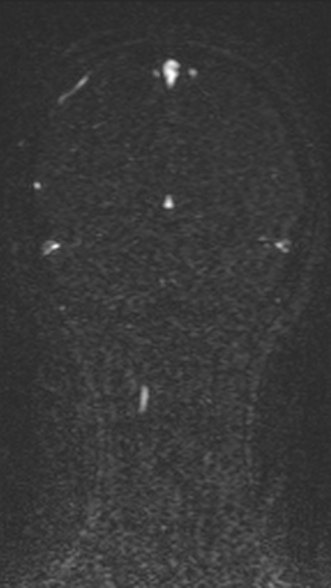 Normal MRI brain with MRV- teenager (Radiopaedia 49425-54553 Coronal MRV 192).jpg