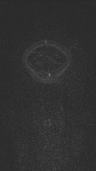 Normal MRI brain with MRV- teenager (Radiopaedia 49425-54553 Coronal MRV 34).jpg