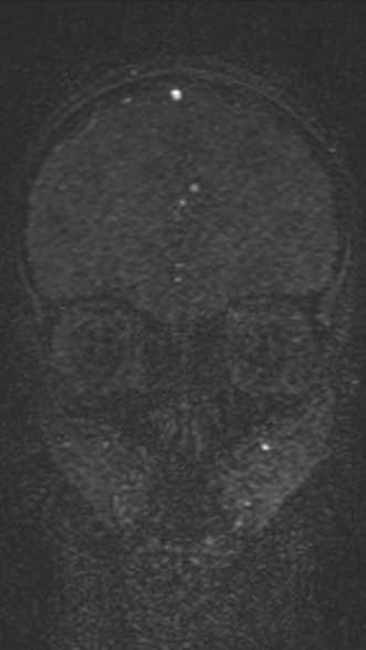 Normal MRI brain with MRV- teenager (Radiopaedia 49425-54553 Coronal MRV 72).jpg