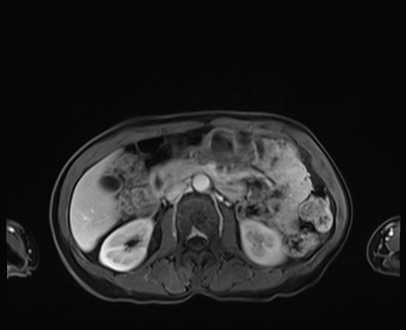 Normal adrenal glands MRI (Radiopaedia 82017-96004 K 43).jpg