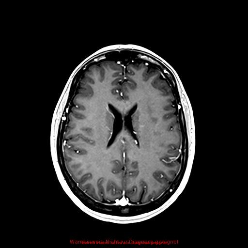 Normal adult brain MRI (non-enhanced and contrast-enhanced) (Radiopaedia 75262-86379 Axial T1 C+ 122).jpg