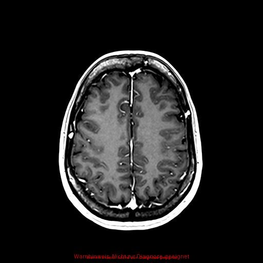 Normal adult brain MRI (non-enhanced and contrast-enhanced) (Radiopaedia 75262-86379 Axial T1 C+ 137).jpg