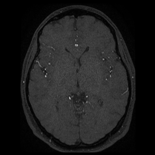 Normal brain MRA (Radiopaedia 41046-43793 Axial MRA 28).png
