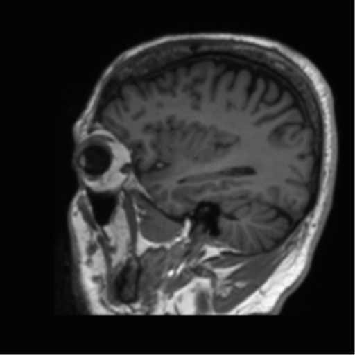 Normal brain MRI (non-focal epilepsy protocol) (Radiopaedia 53917-60040 Sagittal T1 15).png