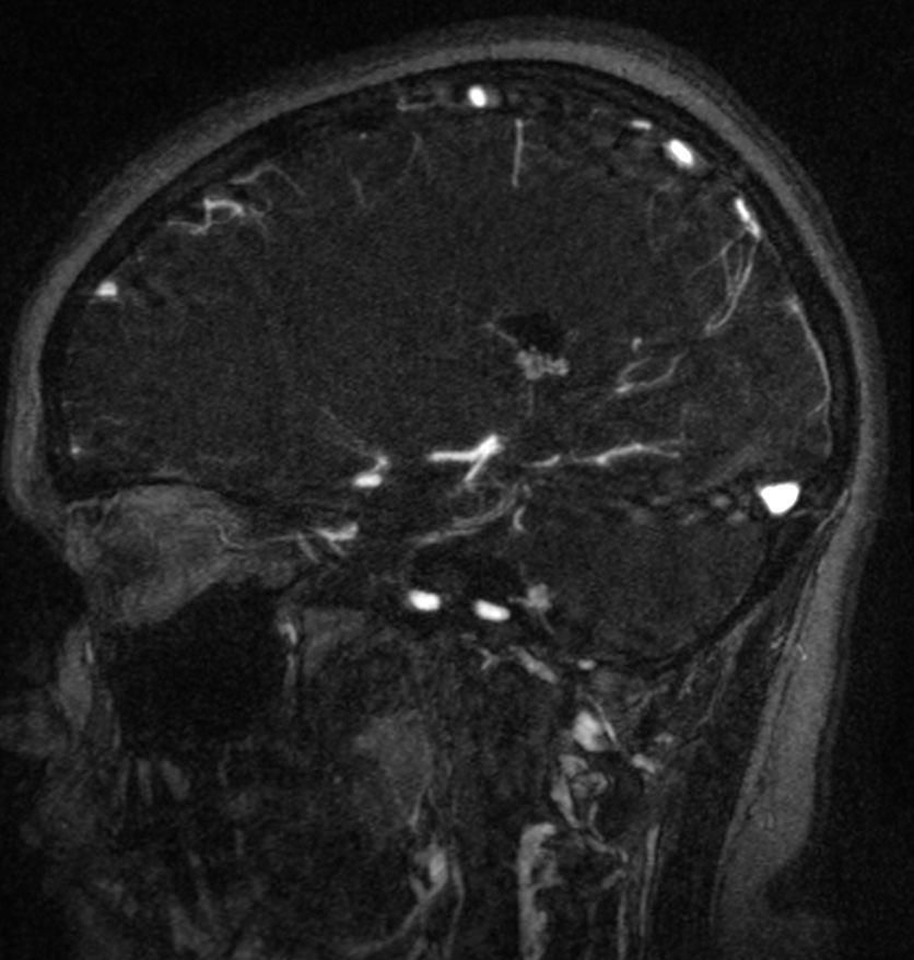 Normal brain MRI and venogram (Radiopaedia 39554-41862 Sagittal MRV 42).jpg