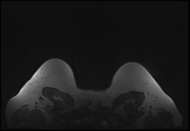 File:Normal breast MRI - dense breasts (Radiopaedia 80454-93850 Axial T1 211).jpg