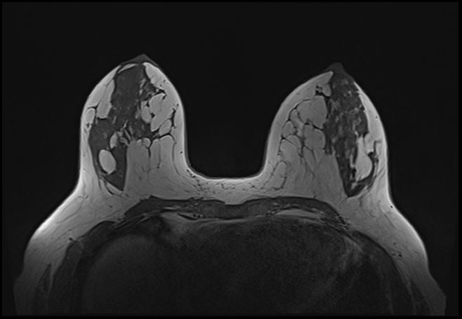 File:Normal breast MRI - dense breasts (Radiopaedia 80454-93850 Axial T1 94).jpg