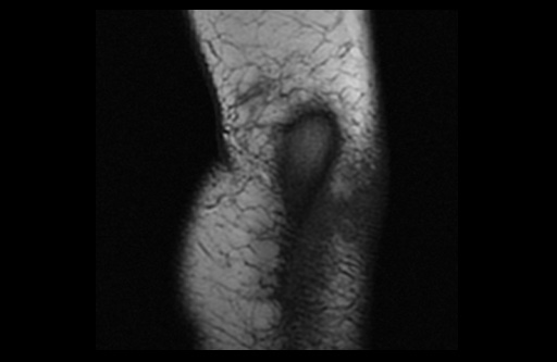 File:Normal elbow arthrograms (Radiopaedia 75550-86805 Coronal T1 1).jpg
