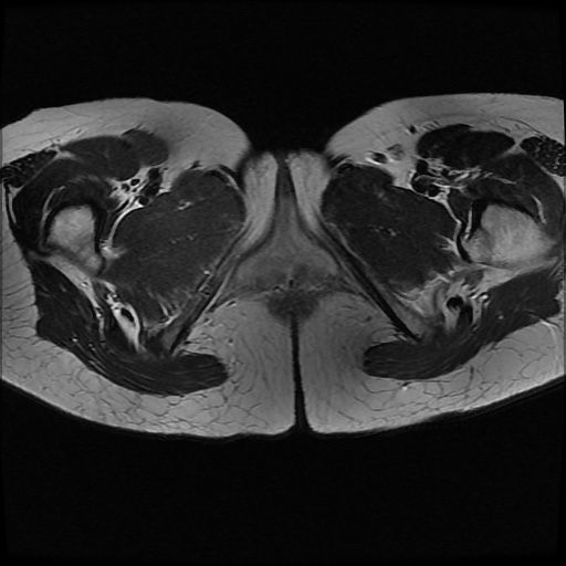 File:Normal female pelvis MRI (retroverted uterus) (Radiopaedia 61832-69933 Axial T2 30).jpg