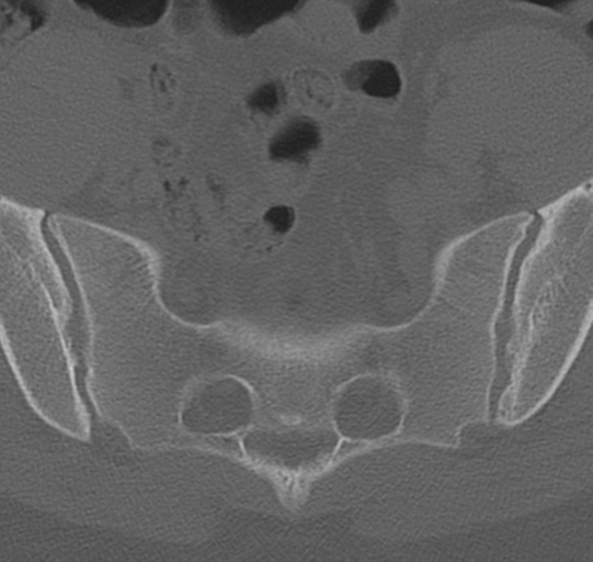 File:Normal lumbar spine CT (Radiopaedia 46533-50986 Axial bone window 76).png
