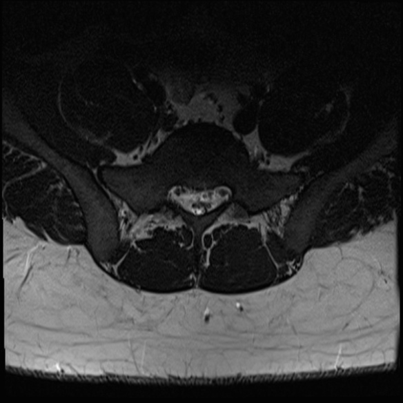 File:Normal lumbar spine MRI (Radiopaedia 47857-52609 Axial T2 30).jpg
