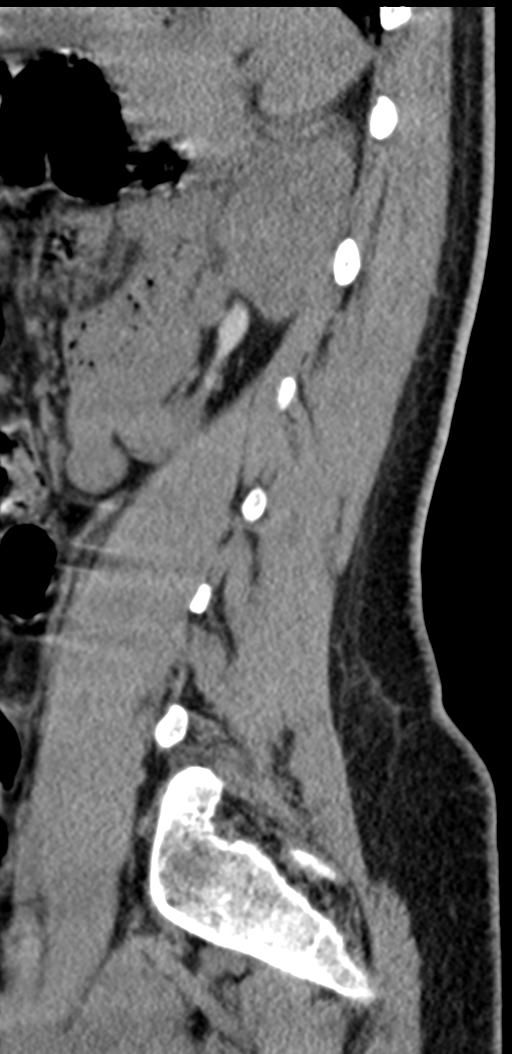 Normal lumbosacral CT (Radiopaedia 37923-39867 E 31).png