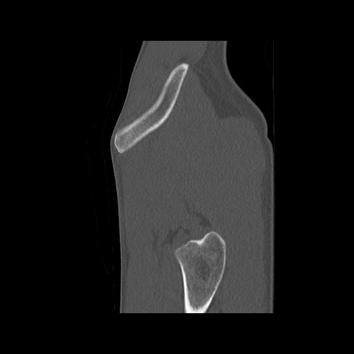 Normal pelvis (Radiopaedia 51473-57238 Sagittal bone window 135).jpg