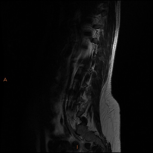File:Normal spine MRI (Radiopaedia 77323-89408 Sagittal T2 3).jpg